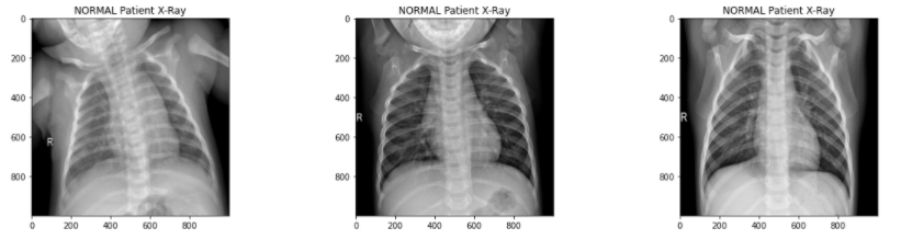 x ray scan of covid 19 affected 1